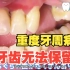 32岁日本小姐姐第一次洁牙，口腔卫生太差了，牙齿松松垮垮