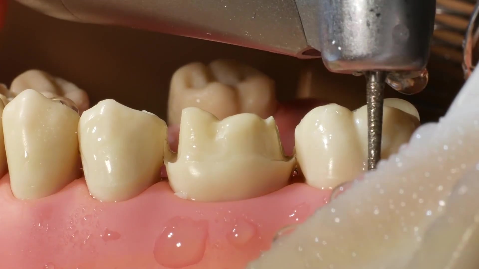 我的兩顆大黃牙怎麼辦？---美白全瓷冠修復 - 案例介紹 - 美容牙科張凱榮醫師
