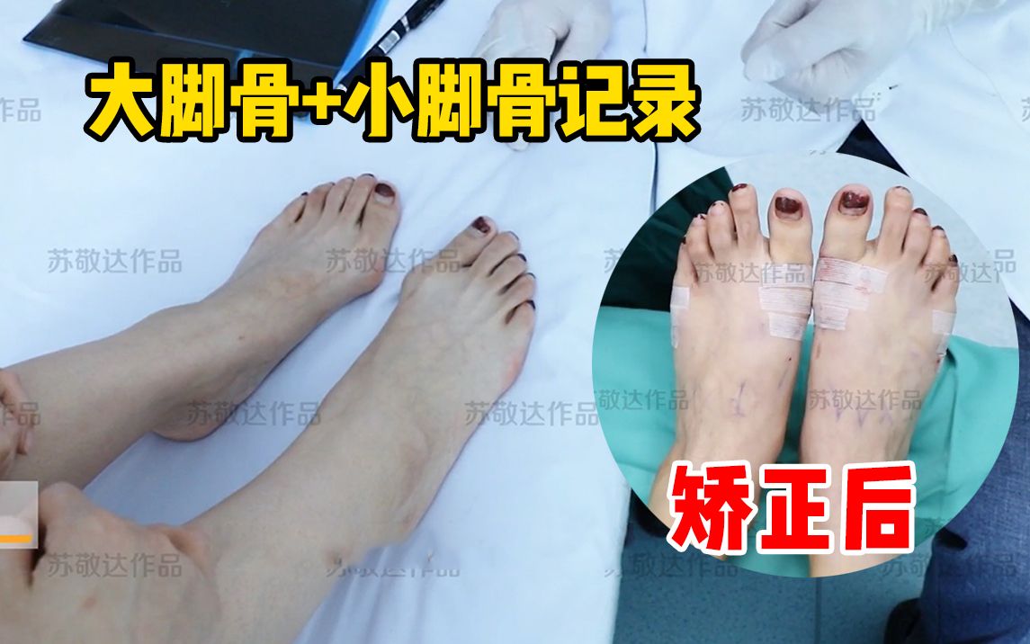 【苏敬达】花3w做大脚骨 小脚骨手术,终于不用被嘲笑了