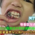 中国8岁女童馨馨患罕见病PAPA综合征7年多，嘴里脓包才手术10多天，又开始长了…心疼啊