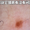 皮肤科医生教你判断哪些痣和哪些不好～#黑色素瘤#黑色素痣