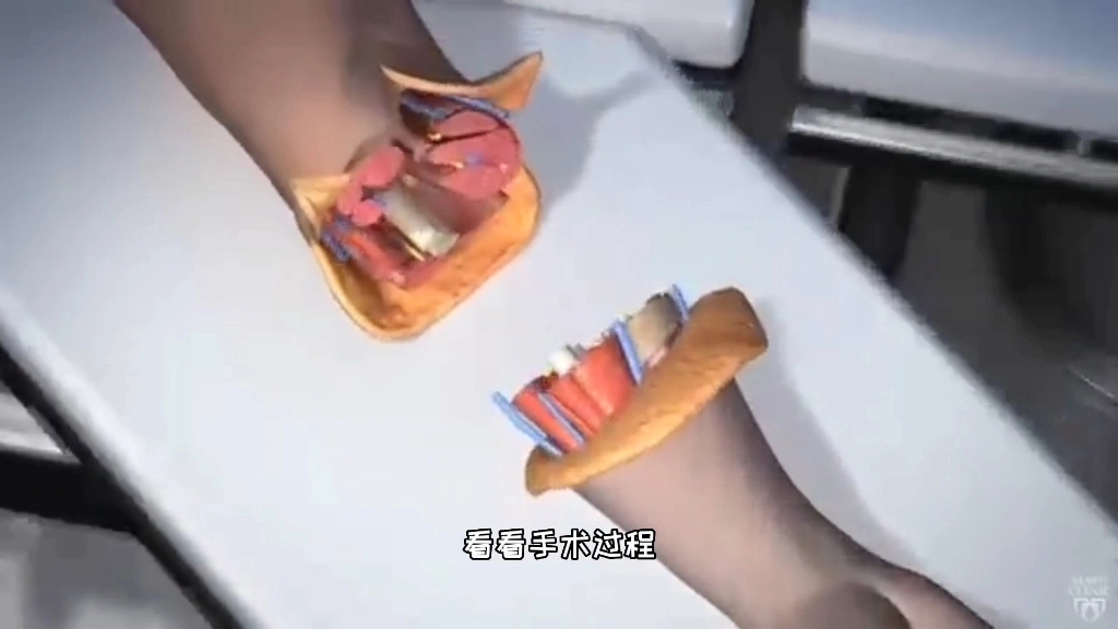 这技术太牛了，断肢再植手术过程，3D演示。。