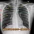 胸片上肺野如何划分的？专科医生讲解知识点，收藏学习