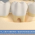 牙周手术治疗（牙槽骨修整术）