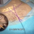 超清晰，椎间孔镜微创治疗腰椎间盘突出手术过程，3D演示。。
