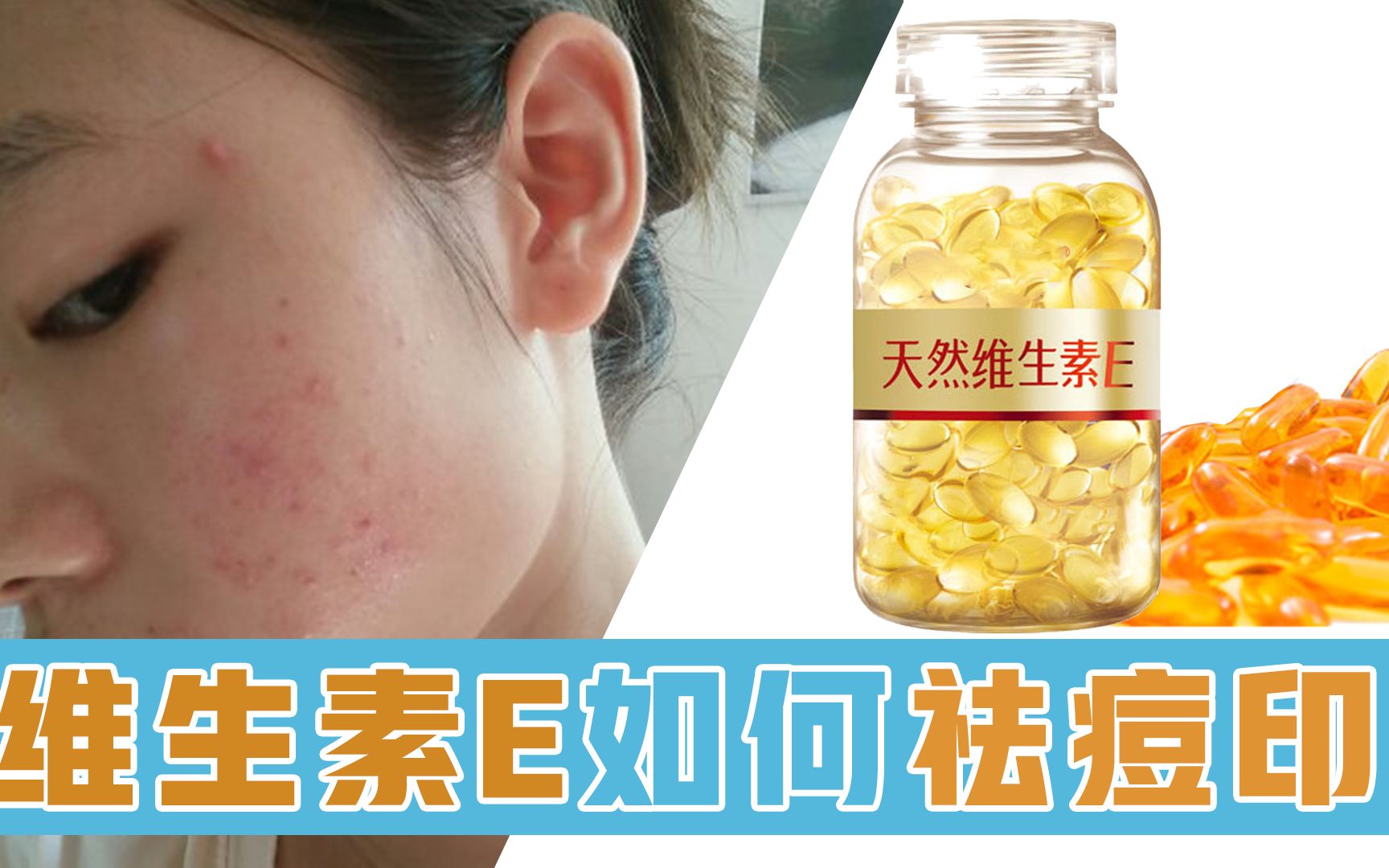 维生素E抹脸上，每天抹一次，按摩十分钟，脸上痘印全消失