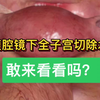 子宫切除全过程，你敢看完吗