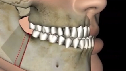 口腔颅颌面畸形矫正过程展示