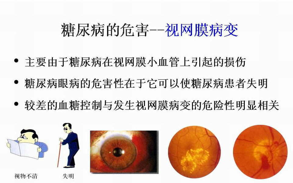 中美医话:糖尿病眼睛模糊:糖尿病对眼睛的损害有哪些?