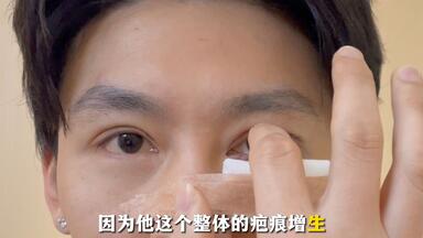 男生适合多宽的<em class="keyword">双眼皮</em>？男生<em class="keyword">双眼皮修复</em>，<em class="keyword">双眼皮宽</em>改窄
