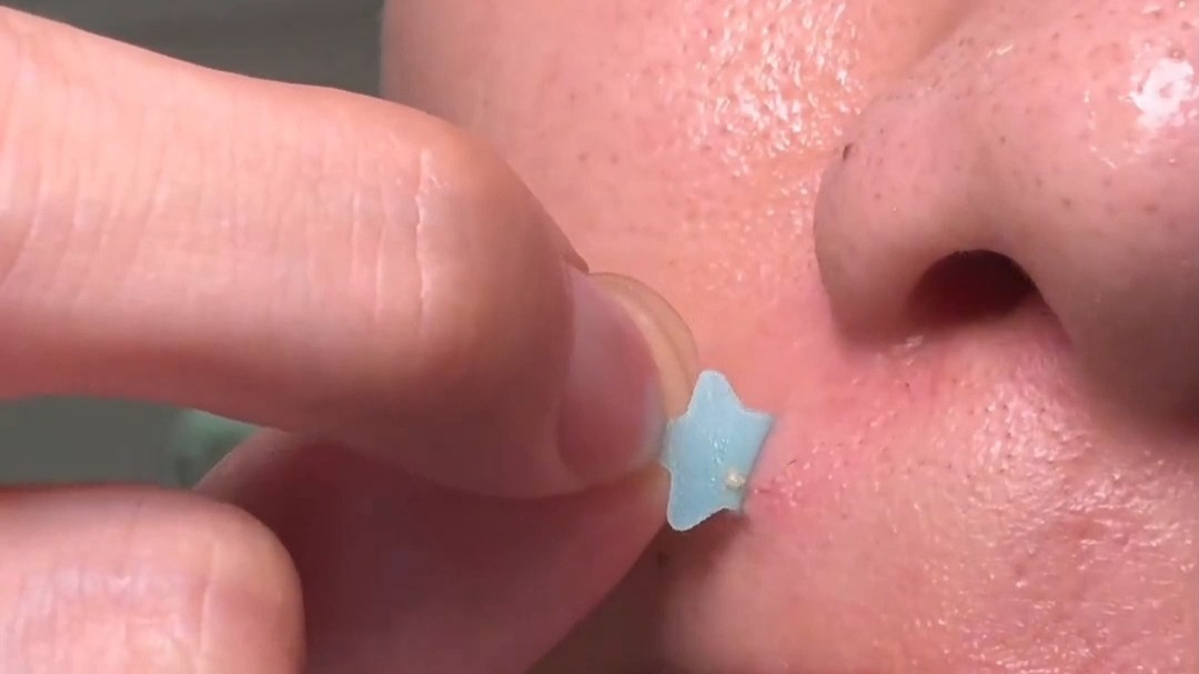 星星痘痘贴，你是我的神！