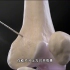 X型腿怎么办，手术矫正过程，3D演示。。