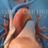 【3D医学动画】心梗系列第三期▁▁冠状动脉成形术（原版+中英双字幕）