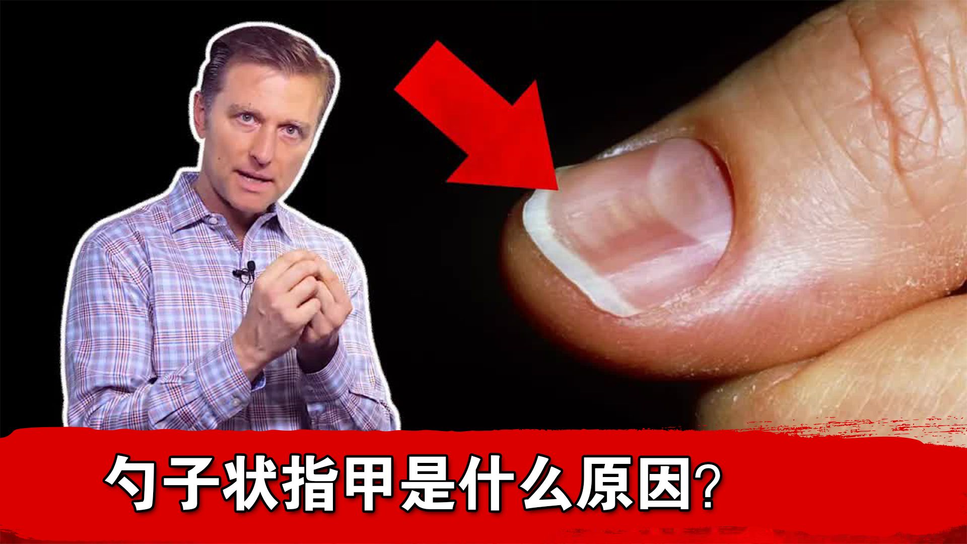 勺子状指甲是什么原因？
