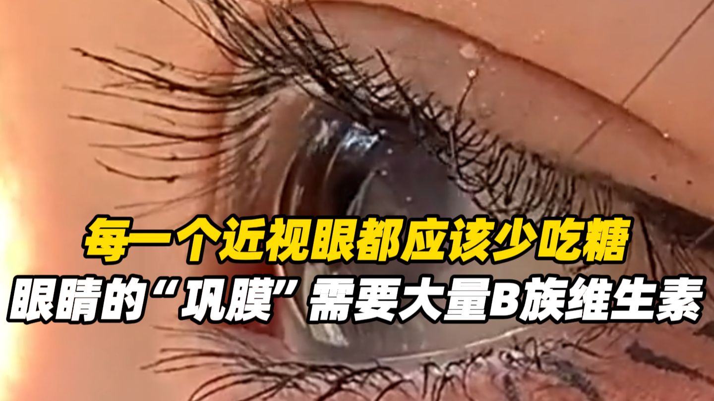 每一个近视眼都应该少吃糖，眼睛的“巩膜”需要大量B族维生素，糖分在人体内代谢时会消耗维生素B1