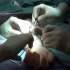 【BBC】断手移植手术——见证赛博朋克的现代医学