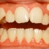 牙齿矫正记录，前后对比判若两“嘴”