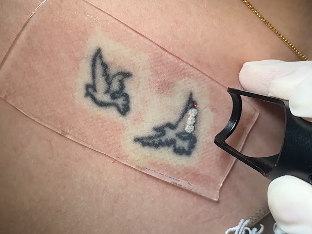 一点都没有感觉，不疼