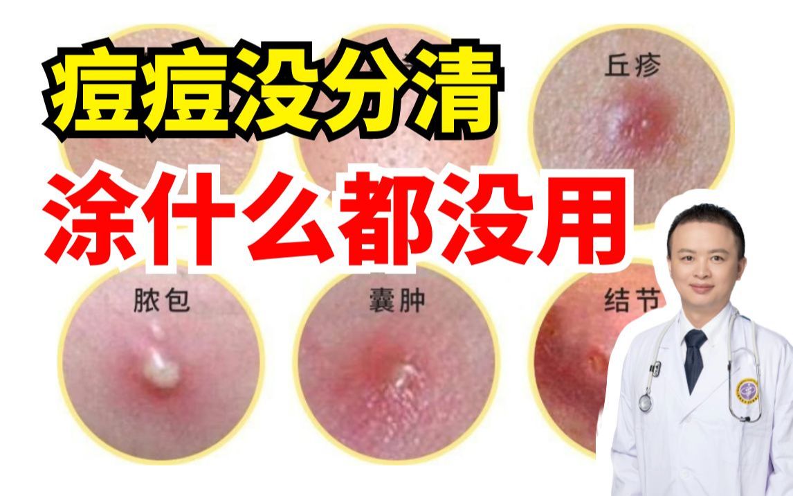 【科普】你能分清楚不同类型的痘，怪不得你脸蛋光滑！