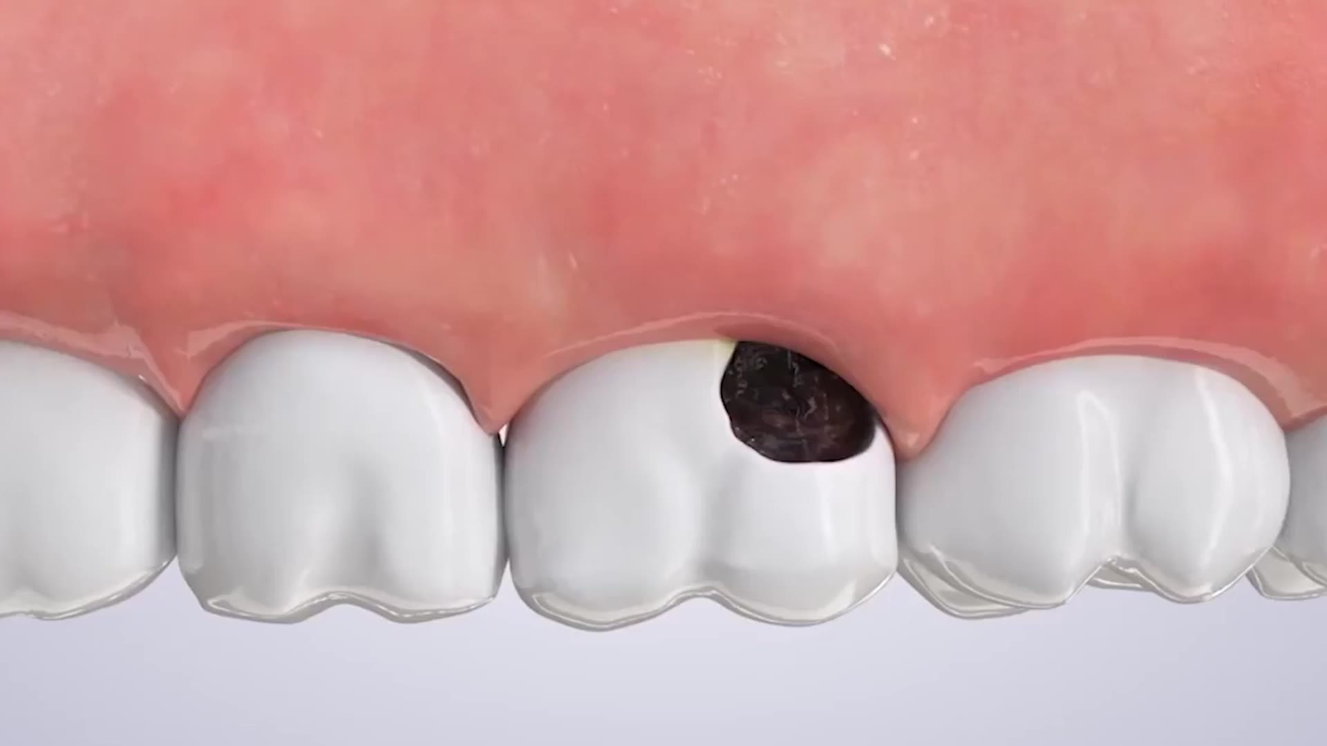 窝沟有黑的就是龋齿吗，可以做窝沟封闭把牙齿上的黑的盖起来吗？