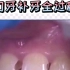 门牙有洞，树脂直接修复，树脂补牙全过程