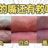 【杨希川教授】嘴唇上的白点，到底是什么