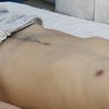 医师实践技能第二站 体格检查 腹部检查-腹部、肝脏叩诊