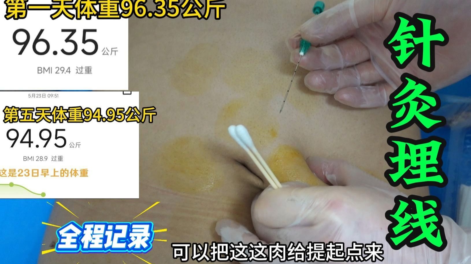 【沉浸式体验针灸埋线】真人体验，不忌口5天掉4斤，带你了解针灸埋线~