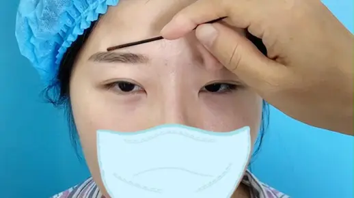 大小眼 提肌无力？