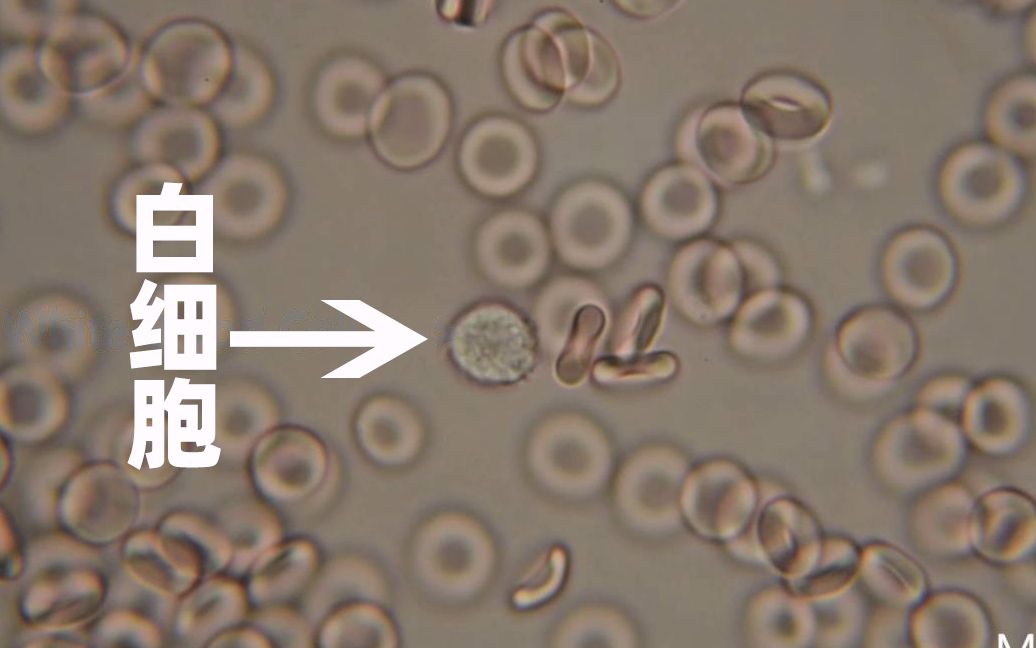 显微镜放大1500倍观察血液里面的红细胞白细胞等高低渗溶液