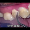 【口腔知识科普】洗牙真的把牙齿洗松动吗？看医生如何操作