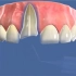 门牙断了怎么办？如果已经伤到牙神经也别发愁，可以根管治疗后，桩冠修复牙齿的功能哦！