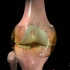 【医学3D】：膝关节骨关节炎的形成过程