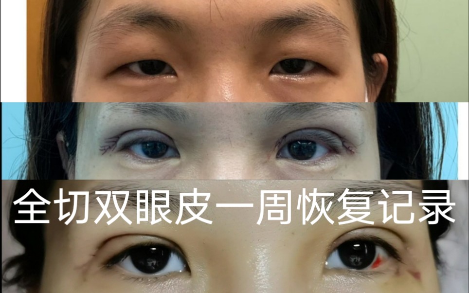 双眼皮手术记录1：术后一周恢复记录+手术过程+术后注意事项