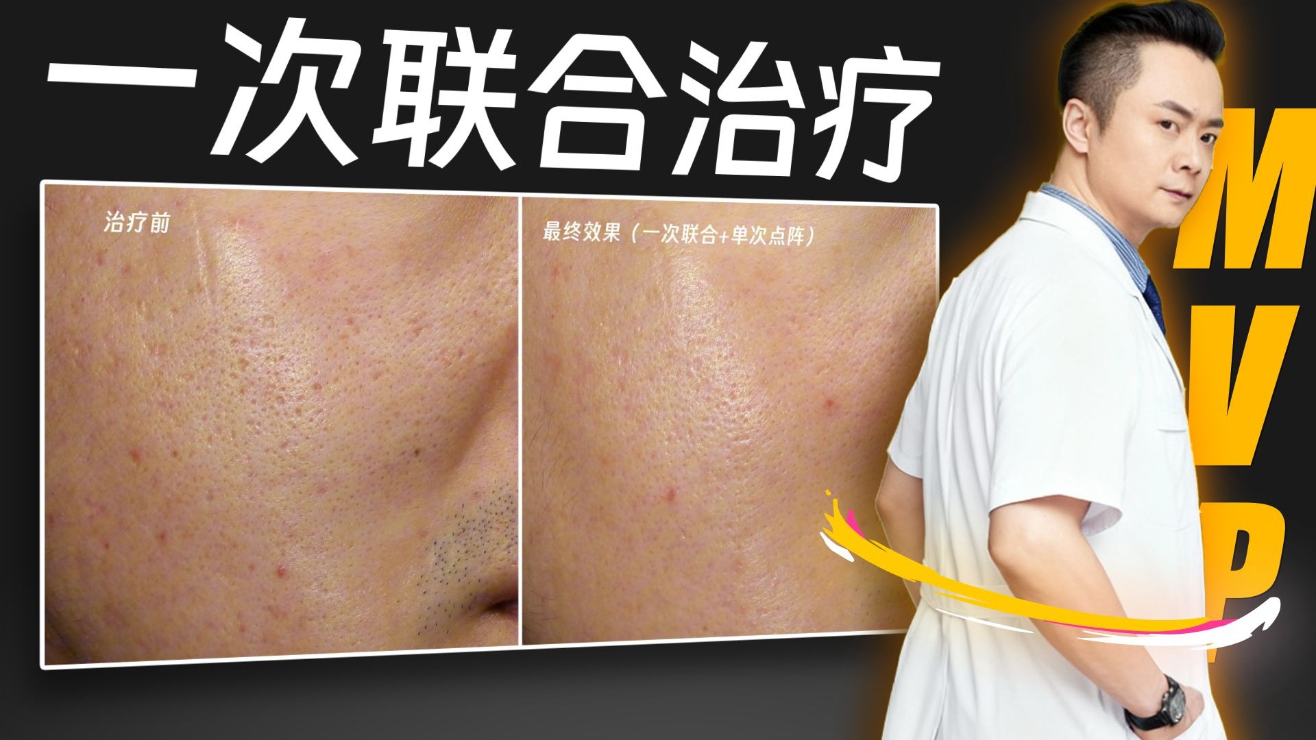 28岁就不适合做痘坑了吗？这个案例只做了一次就恢复7-80%！点阵激光+黄金微针