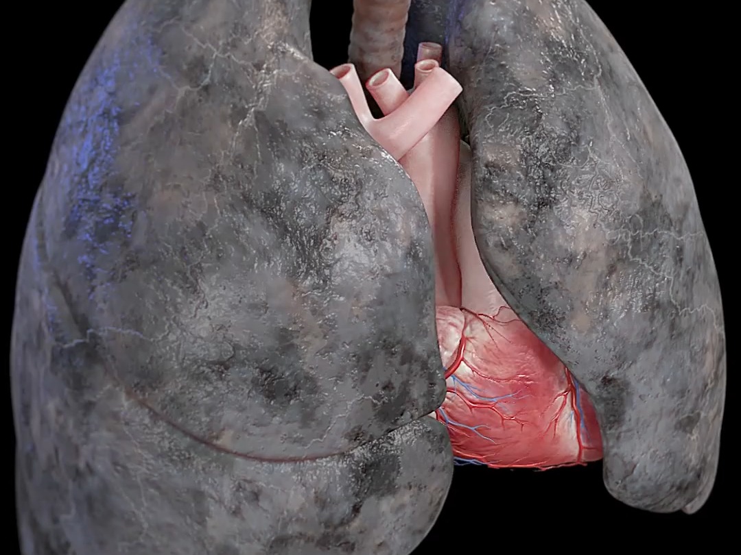 吸烟的肺长这样