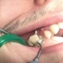 【洗牙】满足强迫症！一般人长不出这么完整的牙结石