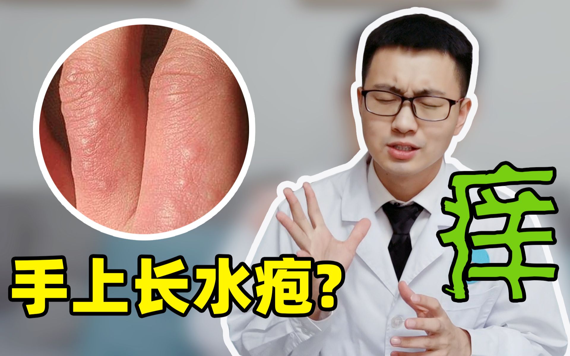 「汗疱疹」如何根治？它与湿疹的关系？与手足癣的区别？都解答在这里了！|手足癣|汗疱疹|湿疹|根治|区别|真菌|症状|治疗|-健康界