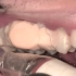 27岁小伙第一次洗牙，牙结石多的都找不到牙了！