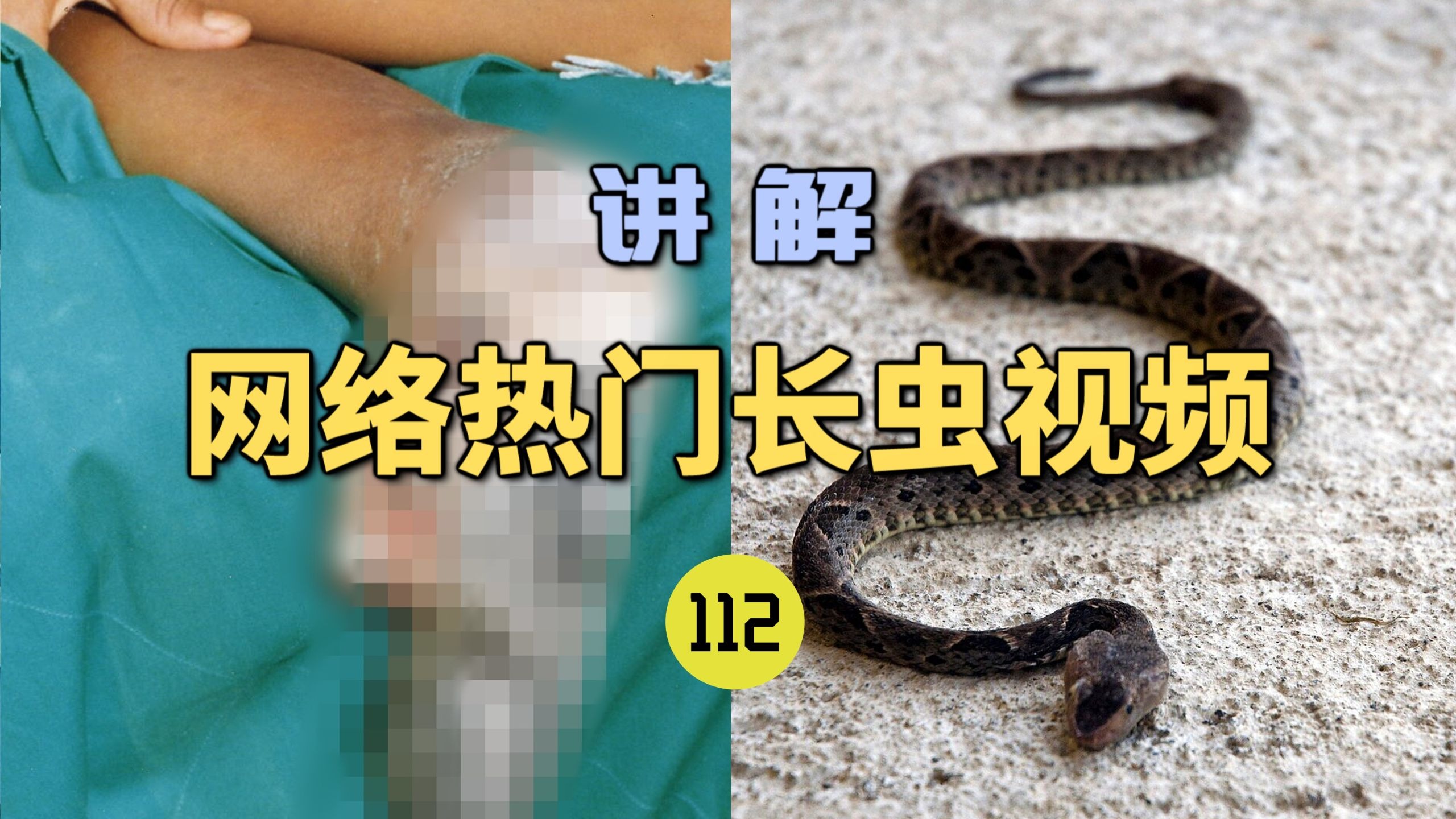 网络热门长虫视频(112)男孩被三色矛头蝮咬伤后没有打血清？整个小腿全部坏死了！