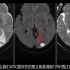 MRI入门教学讲解（1）：DWI序列及信号判读