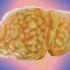 一位男性用夜用感冒药炖鸡 他的肝脏是这么让大脑衰竭的