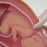 不同胎位的剖宫产动画演示哦