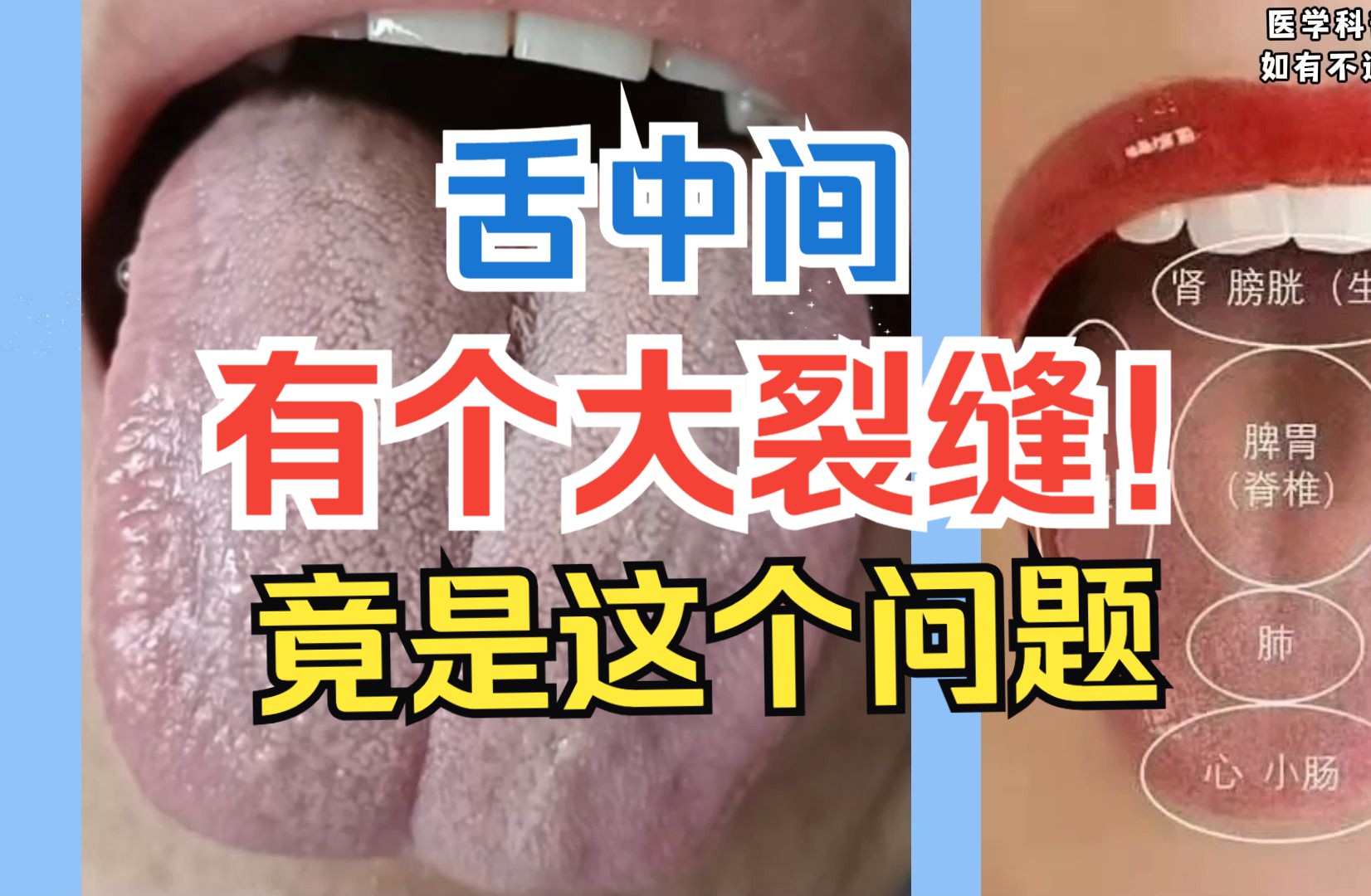 舌诊：舌中间有个大裂缝！大多都是因为这个问题
