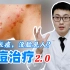 【专业祛痘】为什么你的痘痘那么严重？皮肤科医生告诉你如何正确治疗