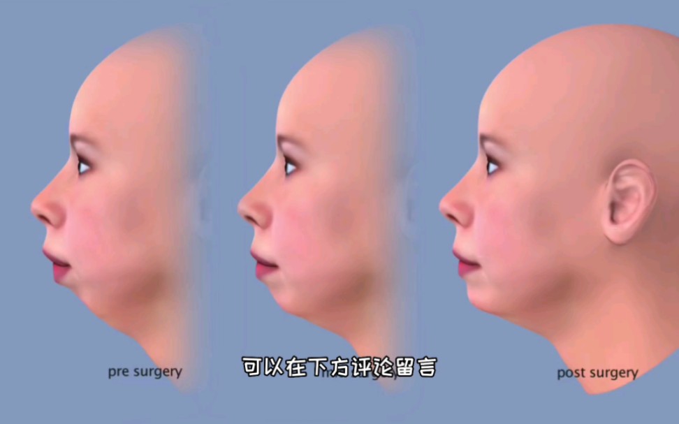 面部整容之短下巴（凸嘴）整形手术过程，3D演示。。