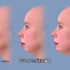面部整容之短下巴（凸嘴）整形手术过程，3D演示。。