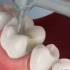 【3D动画】补牙就是用树脂补？那你听说过嵌体修复么~