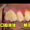 45岁大叔第一次清洁牙齿，洗完好非常酸爽，很解压