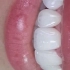牙齿贴面可以改善牙齿缝隙和牙齿颜色觉得牙齿不好看的姐妹们可以约起来了[调皮][调皮][调皮][调皮][调皮]
